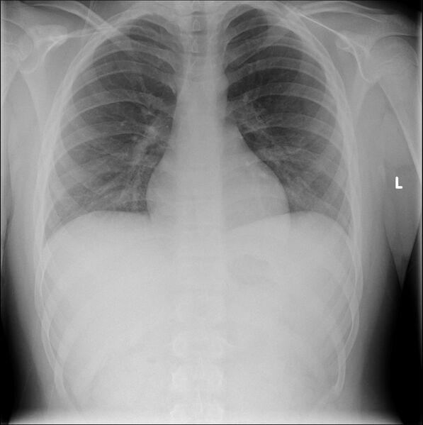 File:Clavicle fracture (on chest radiograph) (Radiopaedia 82439).jpg