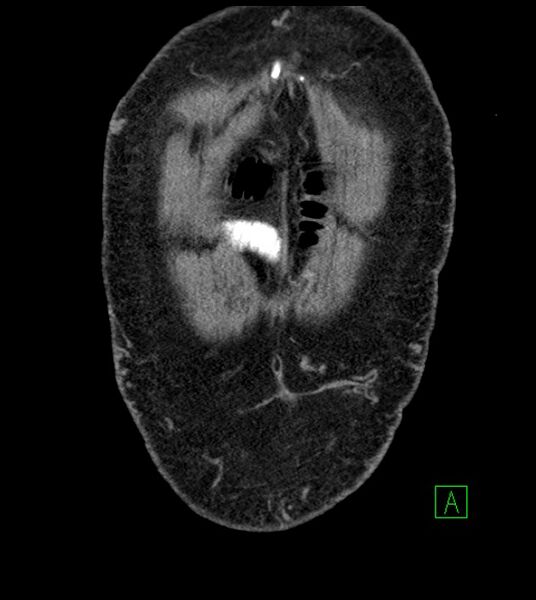 File:Closed-loop small bowel obstruction-internal hernia (Radiopaedia 78439-91096 Coronal non-contrast 16).jpg