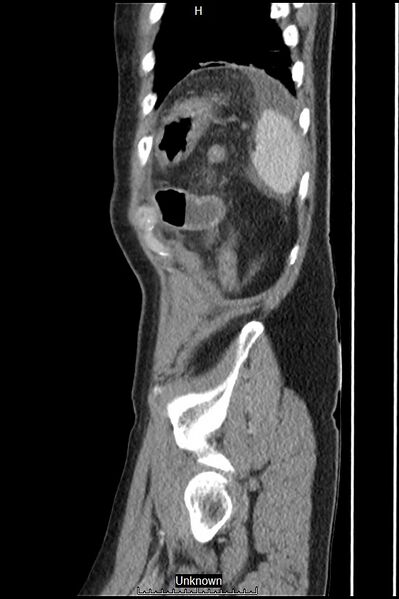 File:Closed loop bowel obstruction and ischemia (Radiopaedia 86959-103180 C 4).jpg
