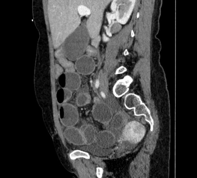 File:Closed loop small bowel obstruction (Radiopaedia 71211-81508 C 50).jpg