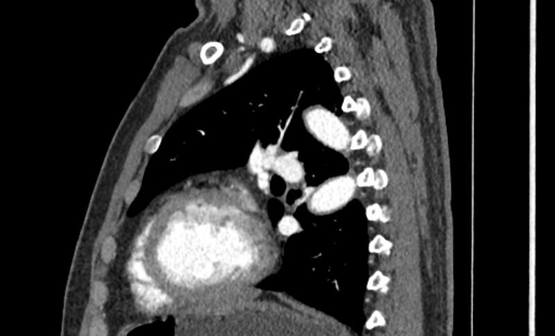 File:Coarctation of the aorta (Radiopaedia 53363-59343 B 44).jpg