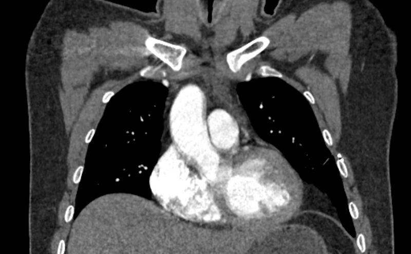 File:Coarctation of the aorta (Radiopaedia 53363-59343 C 22).jpg