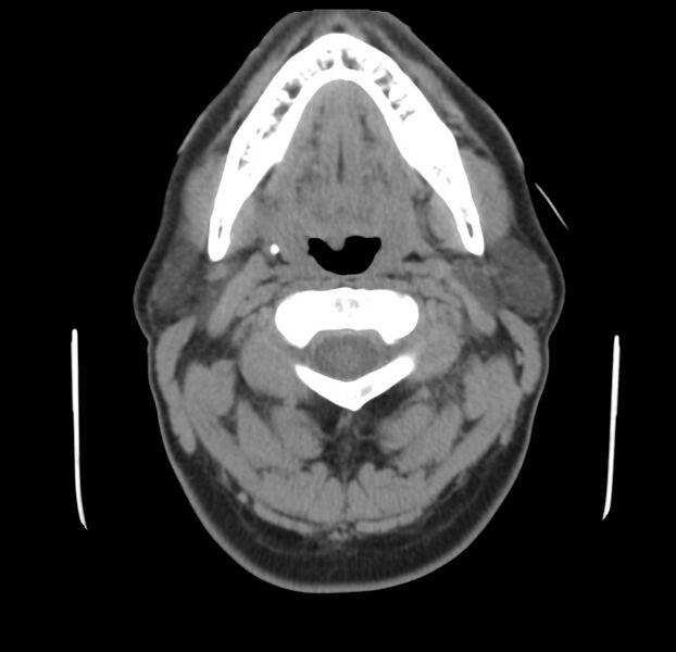 File:Colloid cyst of thyroid (Radiopaedia 22897-22923 Axial non-contrast 17).jpg