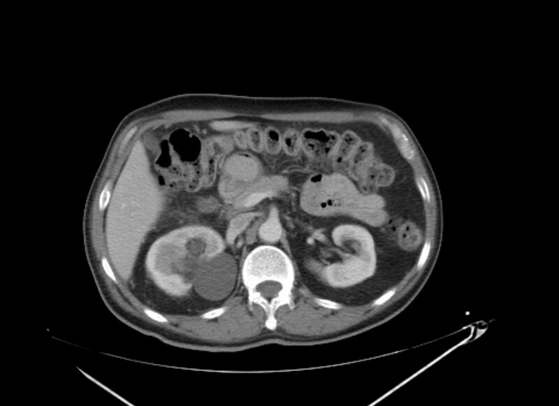 File:Colon cancer mimicking renal cell carcinoma (Radiopaedia 28986-29335 C 25).jpg