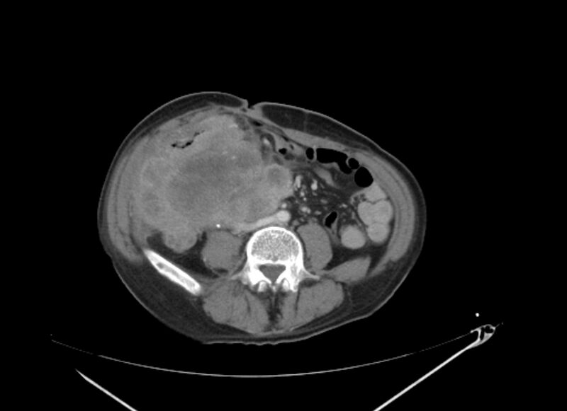 File:Colon cancer mimicking renal cell carcinoma (Radiopaedia 28986-29335 C 46).jpg