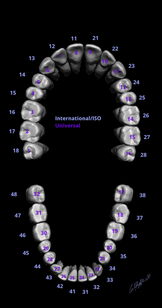 File:Dental notations (illustration) (Radiopaedia 73643).png