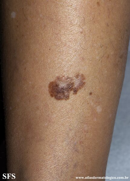 File:Melanoma (Dermatology Atlas 102).jpg