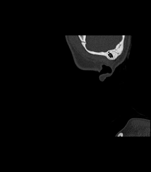 File:Nasoorbitoethmoid fracture (Radiopaedia 90044-107205 Sagittal bone window 9).jpg