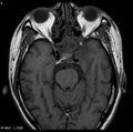 Nasopharyngeal carcinoma (Radiopaedia 4546-6667 Axial T1 2).jpg