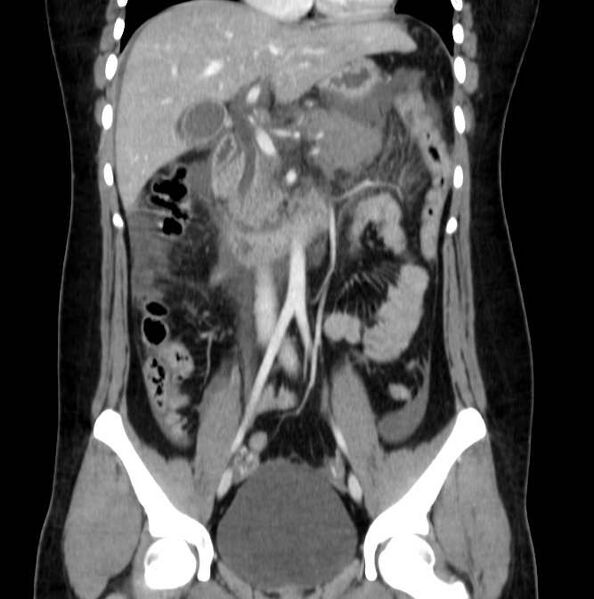 File:Necrotizing pancreatitis (Radiopaedia 23001-23031 B 31).jpg
