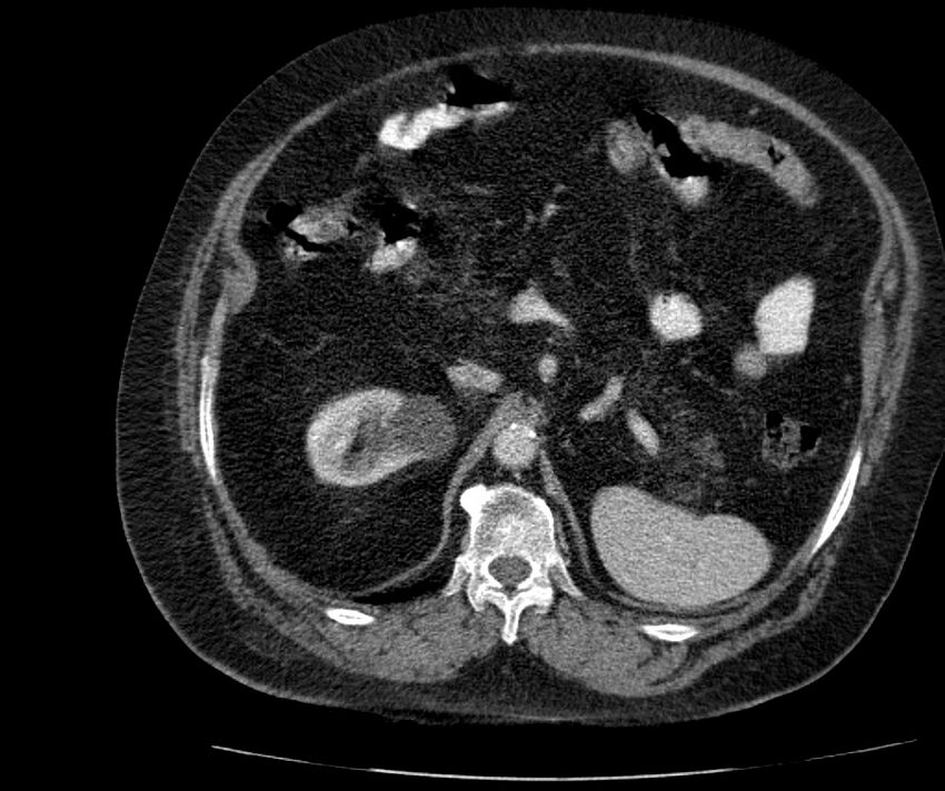 Nephroptosis with inguinal hernia containing perirenal fat (Radiopaedia 56632-63391 C 120).jpg