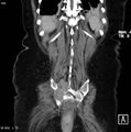 Nerve sheath tumor - malignant - sacrum (Radiopaedia 5219-6987 B 15).jpg