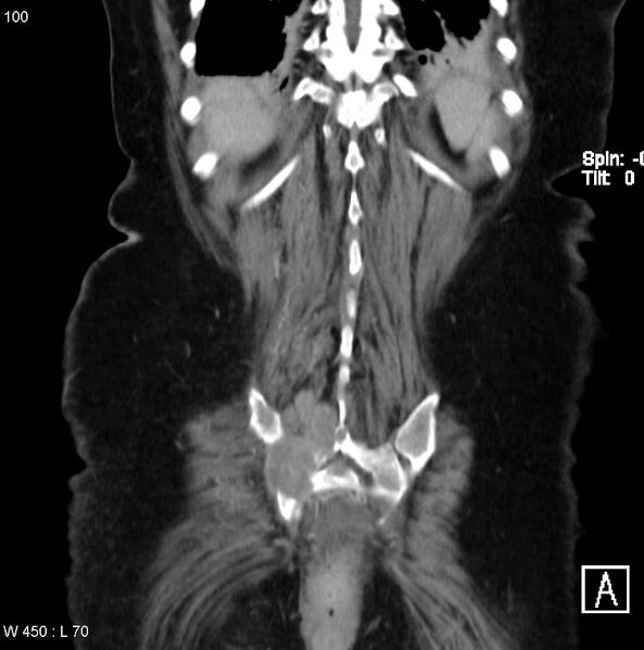 File:Nerve sheath tumor - malignant - sacrum (Radiopaedia 5219-6987 B 15).jpg