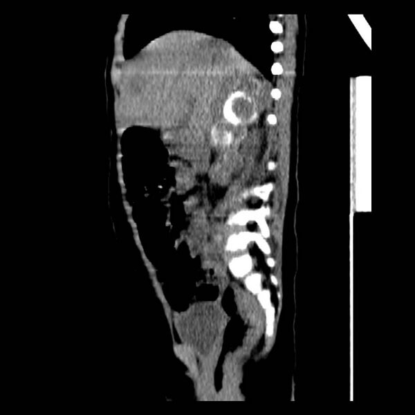 File:Neuroblastoma with skull metastases (Radiopaedia 30326-30960 B 17).jpg