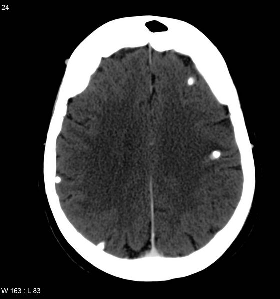 File:Neurocysticercosis (Radiopaedia 7773-8596 C+ delayed 12).jpg