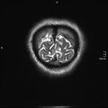 Neurotoxoplasmosis - concentric target sign (Radiopaedia 70644-80784 Coronal T2 6).jpg