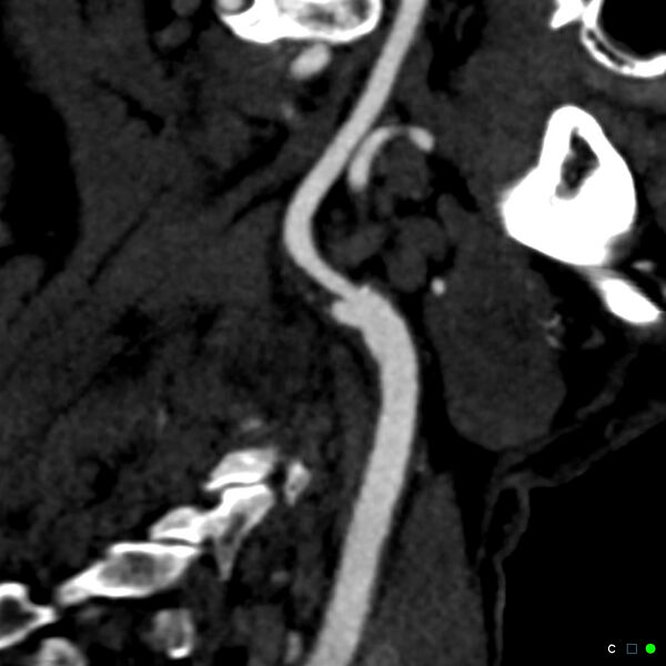 File:Non-occlusive intraluminal internal carotid artery thrombus (Radiopaedia 37751-39658 C 18).jpg