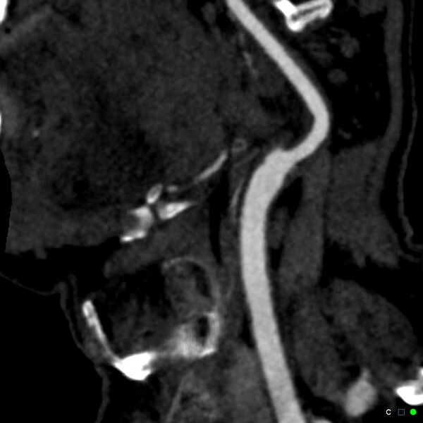 File:Non-occlusive intraluminal internal carotid artery thrombus (Radiopaedia 37751-39658 C 63).jpg