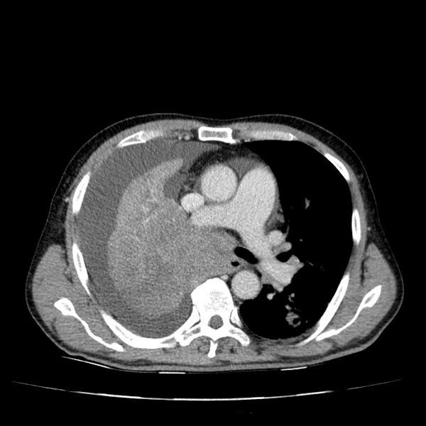 File:Non small-cell lung cancer (Radiopaedia 24467-24769 C+ delayed 28).jpg