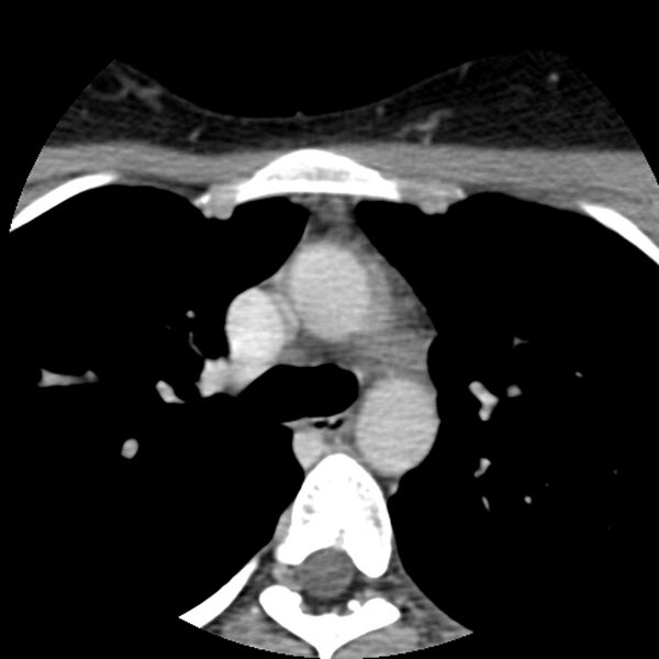File:Normal CT of the neck (Radiopaedia 14575-14500 Axial C+ 80).jpg