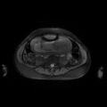 Normal MRI abdomen in pregnancy (Radiopaedia 88001-104541 D 34).jpg