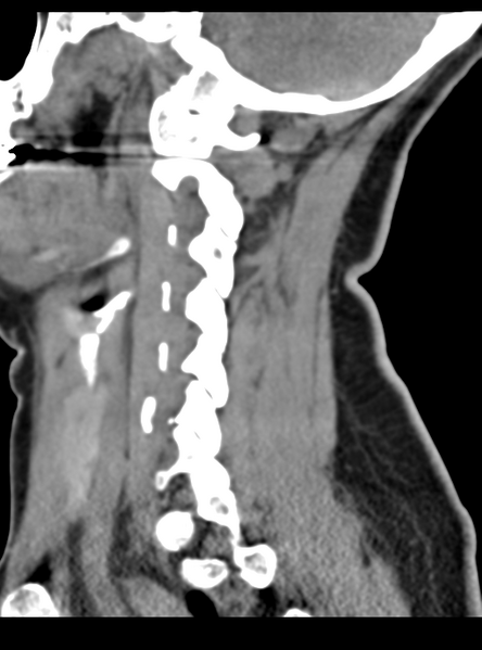 File:Normal cervical spine MRI (including Dixon) (Radiopaedia 42762-45926 C 19).png