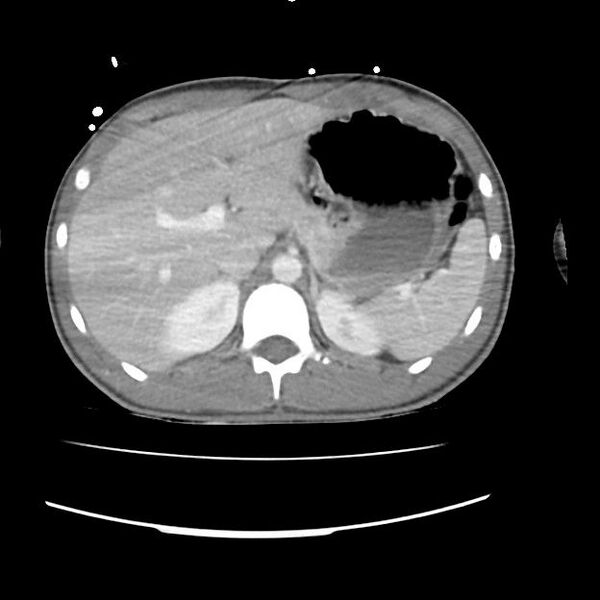 File:Normal dual-phase trauma CT chest,abdomen and pelvis (Radiopaedia 48092-52899 A 55).jpg