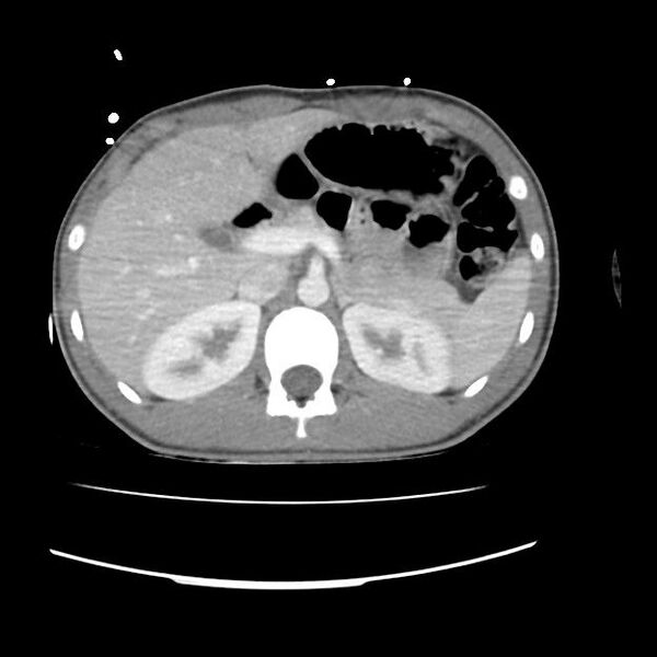 File:Normal dual-phase trauma CT chest,abdomen and pelvis (Radiopaedia 48092-52899 A 58).jpg