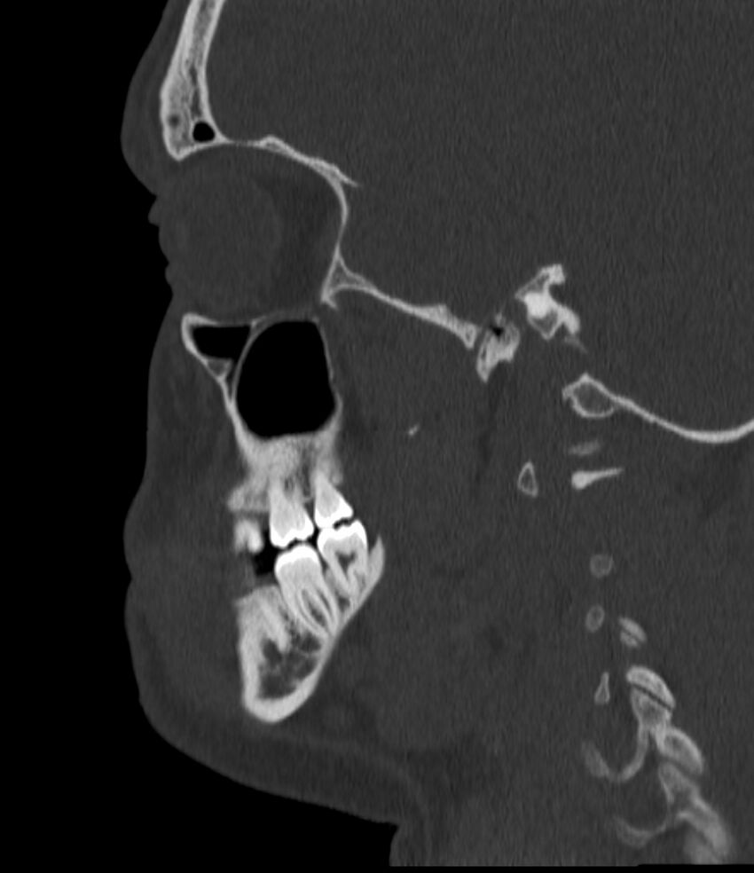 Normal facial bone CT (Radiopaedia 88742-105476 Sagittal bone window 116).jpg