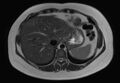 Normal liver MRI with Gadolinium (Radiopaedia 58913-66163 Axial T2 26).jpg