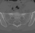 Normal lumbar spine CT (Radiopaedia 46533-50986 Axial bone window 73).png