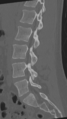 Normal lumbar spine CT (Radiopaedia 46533-50986 Sagittal bone window 59).png