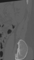 Normal lumbar spine CT (Radiopaedia 46533-50986 Sagittal bone window 8).png