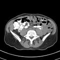Normal multiphase CT liver (Radiopaedia 38026-39996 Axial non-contrast 54).jpg