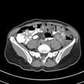 Normal multiphase CT liver (Radiopaedia 38026-39996 Axial non-contrast 59).jpg