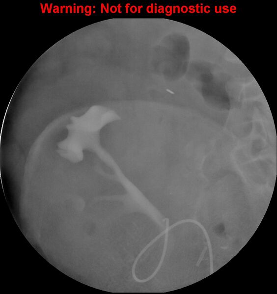 File:Normal retrograde pyelography of a native and transplant kidney (Radiopaedia 40480-43054 Transplant kidney 6).jpg