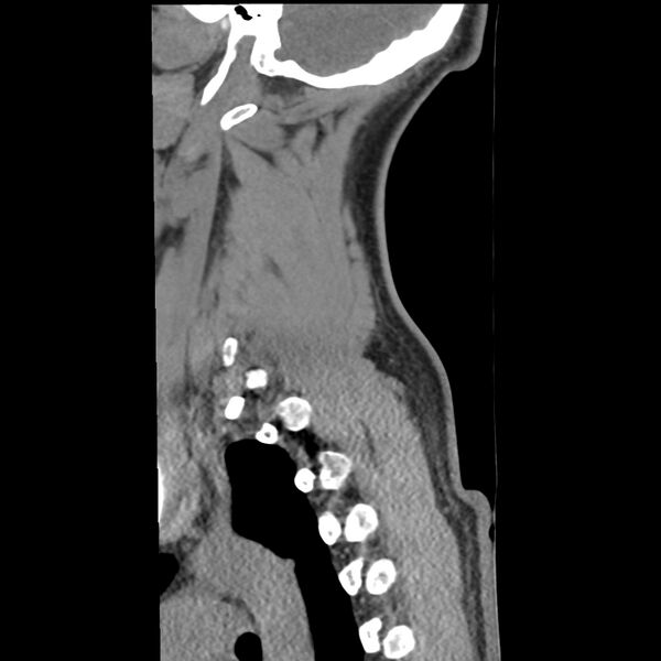 File:Normal trauma spine imaging (Radiopaedia 31753-32686 A 37).jpg