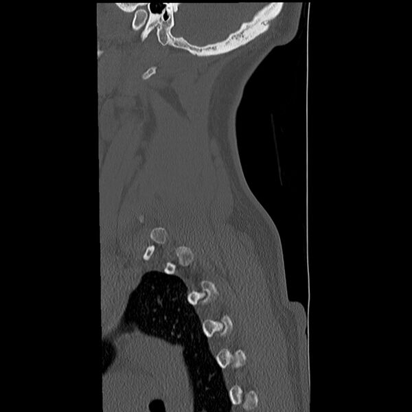 File:Normal trauma spine imaging (Radiopaedia 31753-32686 Sagittal bone window 39).jpg
