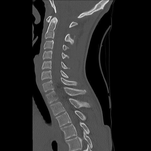 File:Normal trauma spine imaging (age 16) (Radiopaedia 45335-49358 Sagittal bone window 20).jpg