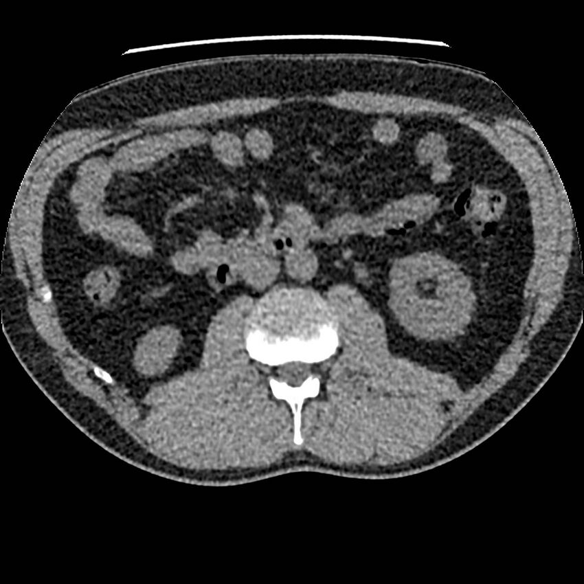 Obstructing ureteric calculus and ureteric anatomy (Radiopaedia 62730-71042 Axial non-contrast 54).jpg