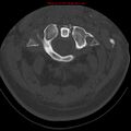 Occipital condyle fracture (Radiopaedia 18366-18208 Axial bone window 18).jpg