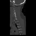 Occipital condyle fracture (Radiopaedia 31755-32691 Sagittal bone window 33).jpg