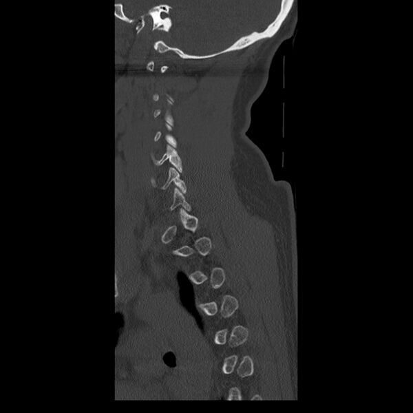 File:Occipital condyle fracture (Radiopaedia 31755-32691 Sagittal bone window 33).jpg