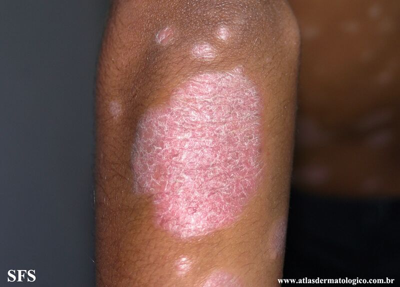 File:Psoriasis (Dermatology Atlas 90).jpg