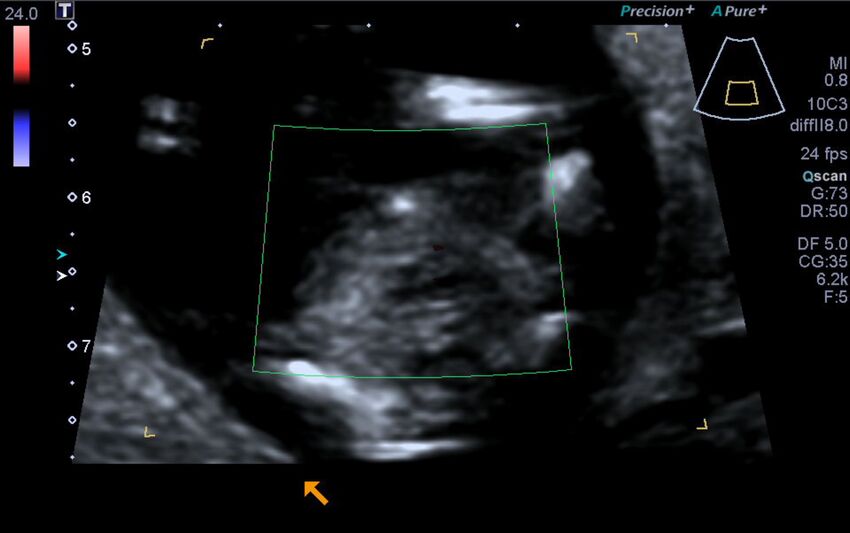 1st trimester nuchal-morphology ultrasound (Radiopaedia 44706-48477 Heart views cine with colour 152).jpg