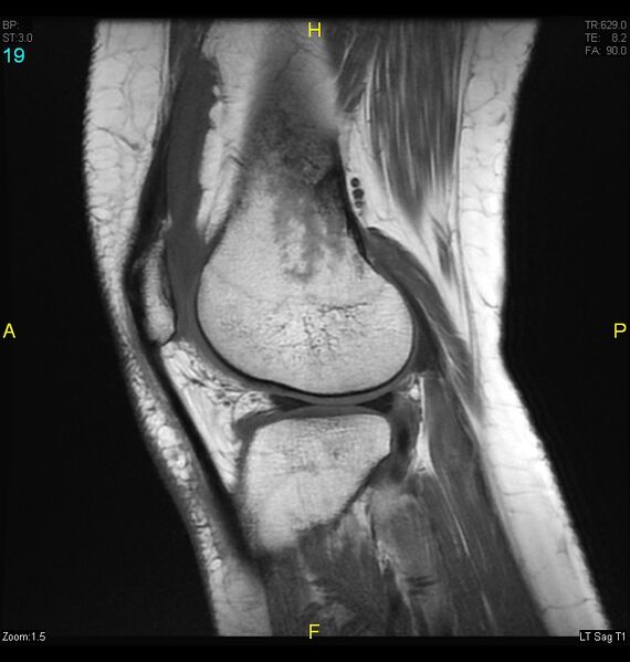 File:ACL mucoid degeration with cystic changes (Radiopaedia 48428-53341 Sagittal T1 17).jpg