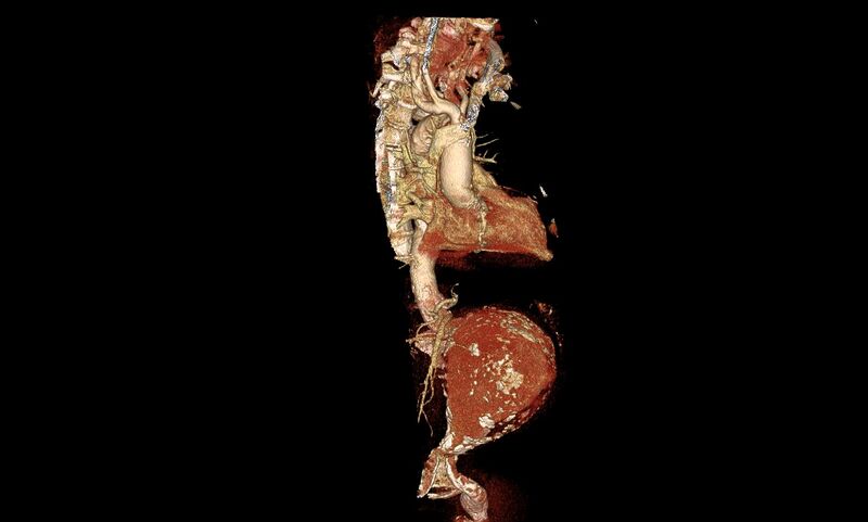 File:Abdominal aortic aneurysm- extremely large, ruptured (Radiopaedia 19882-19921 3D 23).jpg