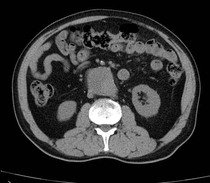 File:Abdominal aortic aneurysm (Radiopaedia 22421-22458 non-contrast 25).jpg