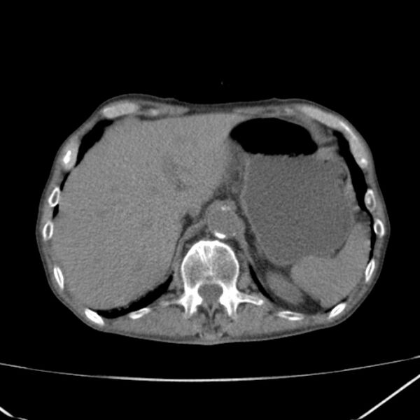 File:Abdominal aortic aneurysm (Radiopaedia 23703-23856 Axial non-contrast 11).jpg