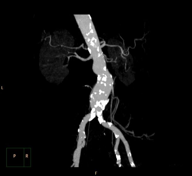 File:Abdominal aortic aneurysm (Radiopaedia 23703-23856 MIP 12).jpg